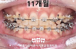 수술후