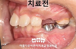 수술전