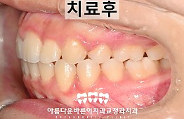 수술후