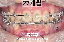 수술후