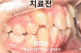 수술전