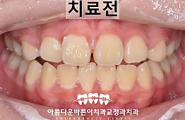 수술전