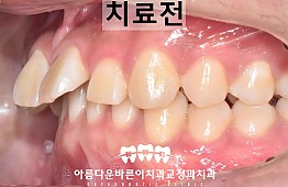 수술전