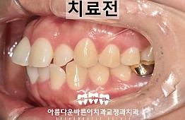 수술전