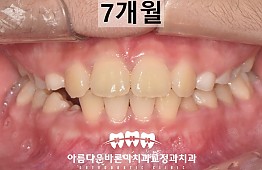 수술후