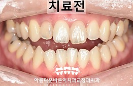 수술전