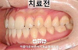 수술전