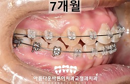 수술후
