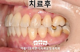 수술후