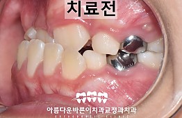 수술전