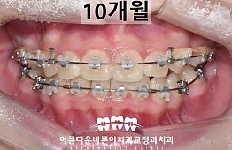 수술후