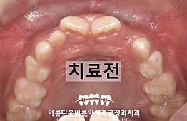 수술전