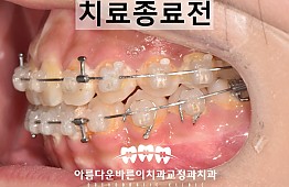 수술후