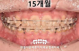 수술후