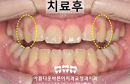 수술후