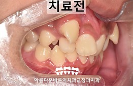 수술전