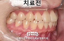 수술전