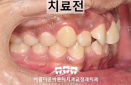 수술전
