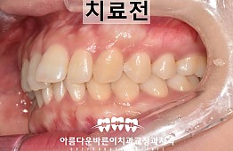 수술전