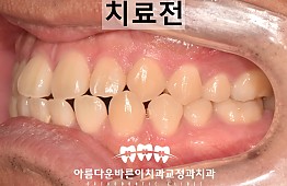 수술전