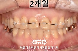 수술후