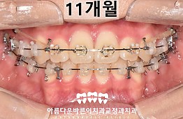수술후