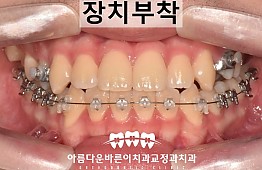 수술후