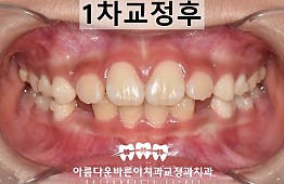 수술후