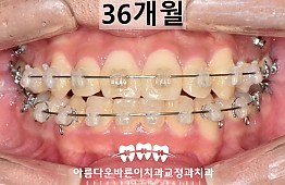 수술후