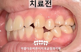 수술전