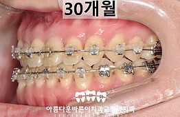 수술후