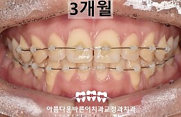 수술후