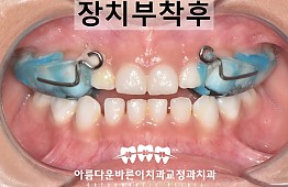 수술후