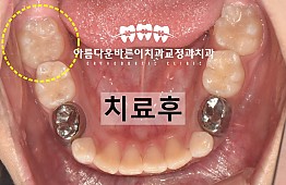 수술후