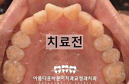 수술전