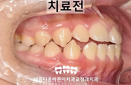 수술전