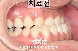 수술전