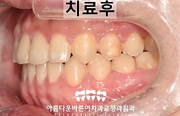 수술후