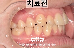 수술전