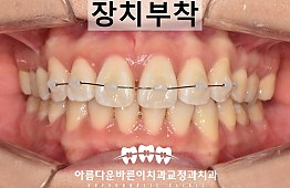 수술후