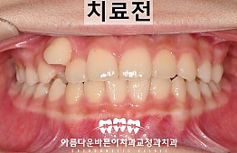 수술전