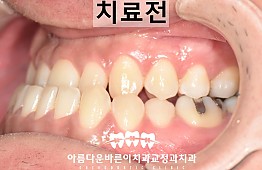 수술전