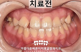 수술전