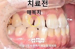 수술전