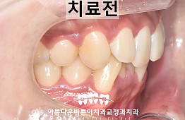 수술전