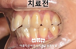 수술전