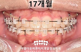 수술후