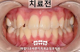 수술전