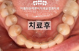 수술후