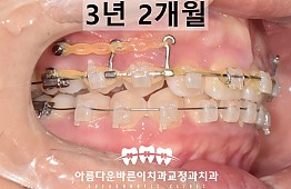 수술후